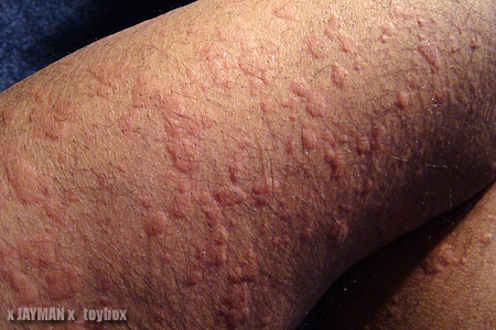 allergic reaction rash. into a hive-like rash.